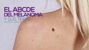 El ABCDE del melanoma y sus tipos
